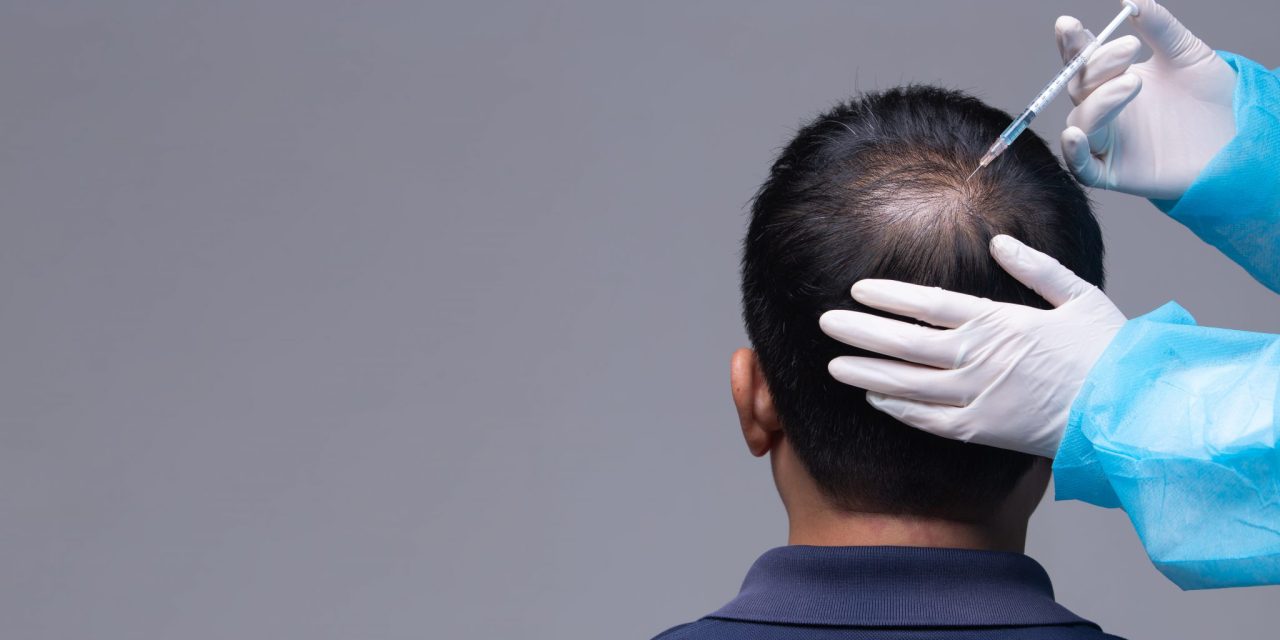 Transplantasi Rambut Gagal? Dokter Ungkap Penyebab Utama