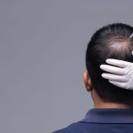 Transplantasi Rambut Gagal? Dokter Ungkap Penyebab Utama