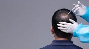 Transplantasi Rambut Gagal? Dokter Ungkap Penyebab Utama