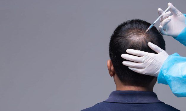 Transplantasi Rambut Gagal? Dokter Ungkap Penyebab Utama